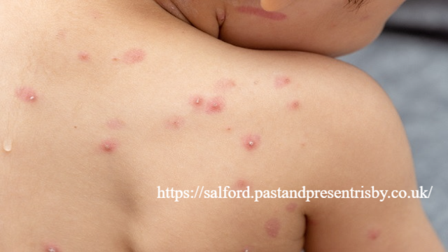 Mengenali Gejala Cacar Air pada Anak: Panduan Lengkap