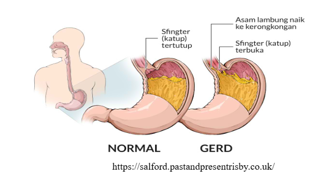 Mengenali Gejala Asam Lambung Kambuh: Panduan Lengkap