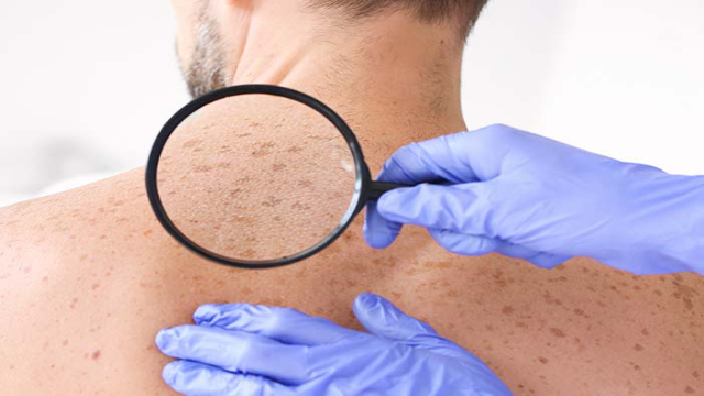 Gejala Lentigo: Bintik-bintik Kecil yang Tidak Berbahaya